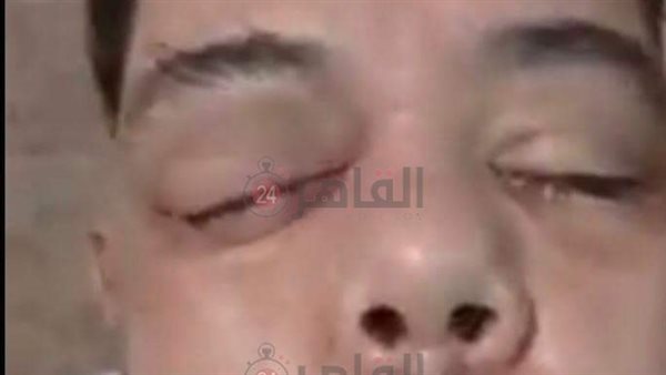 المريض بالفطر الأسود