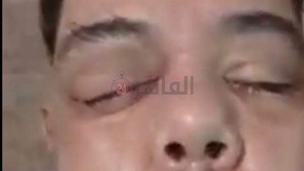 حالة مصاب بالفطر