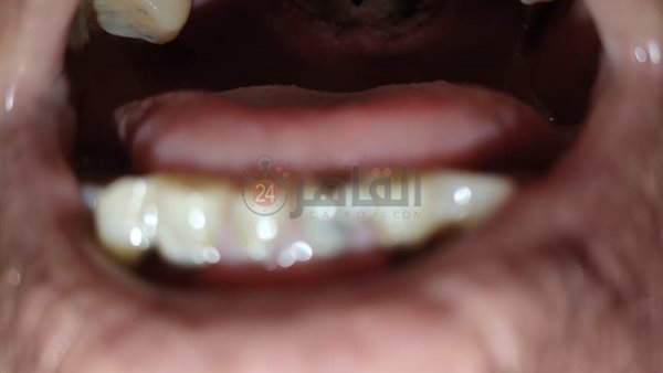 صورة المصابة بالفطر