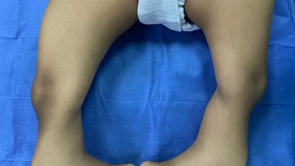 تقويم اعوجاج ساقي