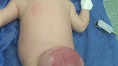 فريق طبي بمستشفى أطفال بنها ينجح في استئصال ورم لطفل عمره شهران 