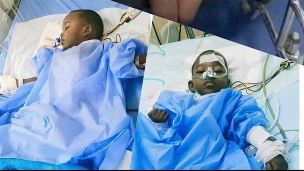 فصل التوأم الملتصق