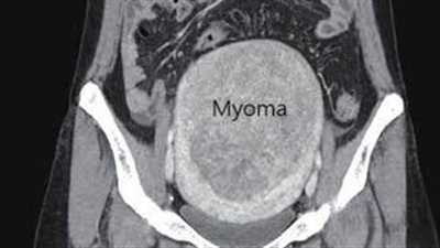 فريق طبي بأورام طنطا ينجح في إزالة ورم ليفي ضخم من رحم سيدة