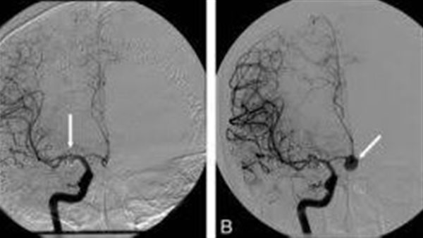 التمدد الوريدي في