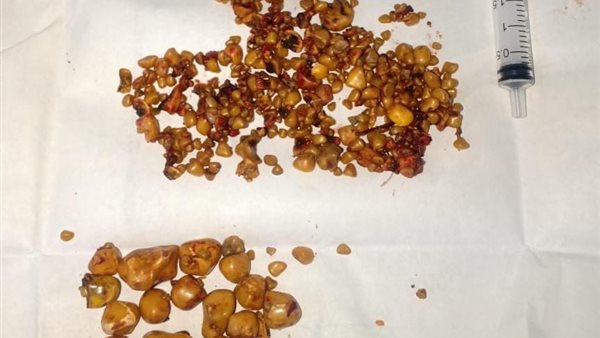 الحصوات المستخرجة