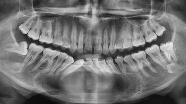 استئصال كيس من عظام