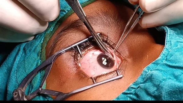 علاج حول وارتخاء