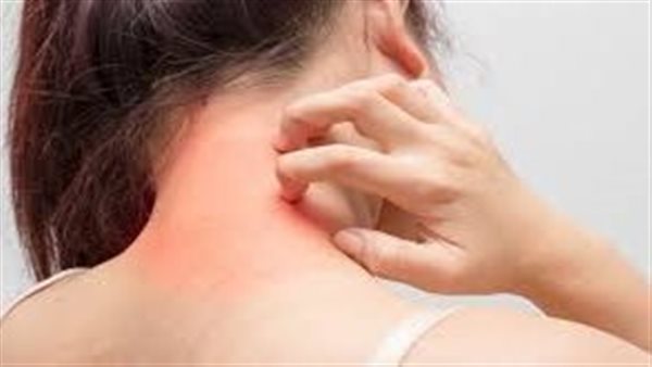 سرطان الجلد