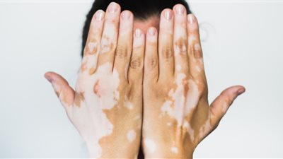 بشرى سارة.. أمريكا تجيز استخدام أول علاج للبهاق