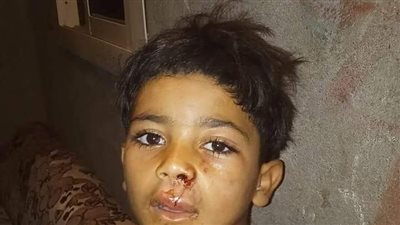 6 صور ترصد واقعة هجوم كلب مسعور على 23 طفلًا بالفيوم