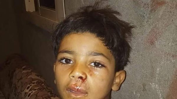 أحد الأطفال المصابين