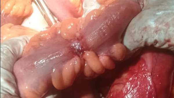 استئصال ورم نادر