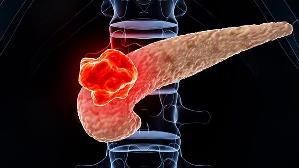 سرطان البنكرياس 