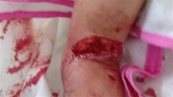 كلب مسعور يهاجم طفلة