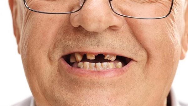 فقدان الأسنان والخرف