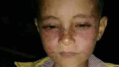 من رحم المعاناة يولد الصبر.. حكاية طفل القمر الملعون بالتنمر 