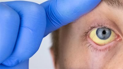 قيء وارتفاع درجة الحرارة واصفرار العين.. تعرف على أعراض التهاب الكبد 