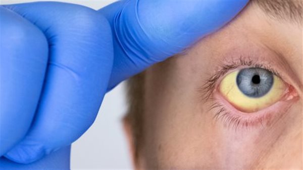 إصفرار العين