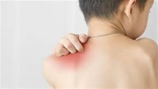 مرض السمكية- أرشيفية