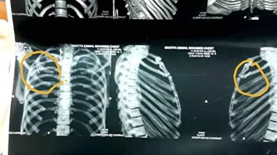 فريق طبى ببنها الجامعي يستخرج 