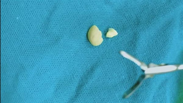 استخرج حبة سوداني