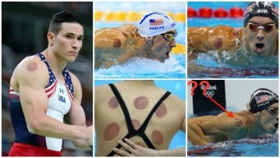 استخدام الرياضيين للحجامة من جديد يلفت الأنظار في أولمبياد طوكيو (صور)