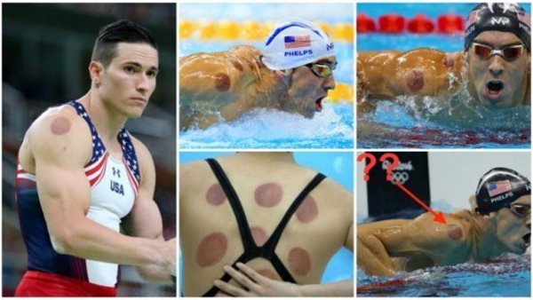 استخدام الحجامة في