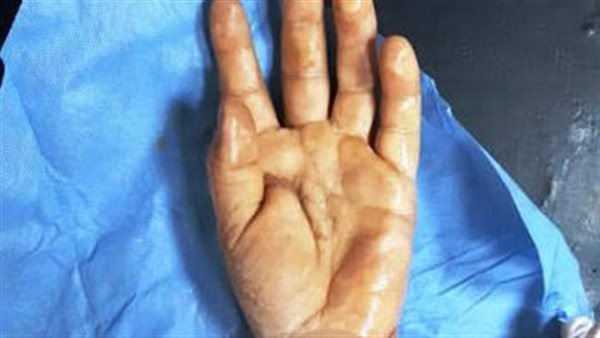 كف يد - أرشيفية 