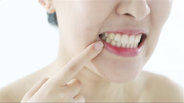 تقرحات الفم