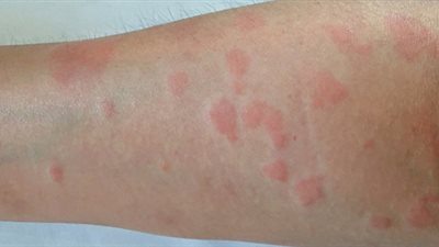 خطر يهدد جسم الإنسان...ما هو مرض الذئبة الحمراء؟