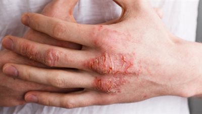 طرق وقائية من مرض التهاب الجلد التأتبي