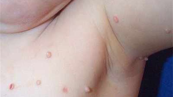 مليساء المعدية 