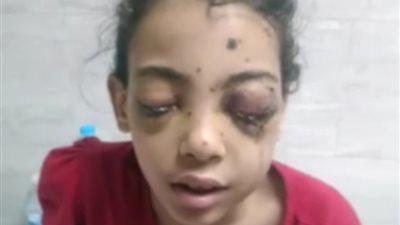 والد طفل أصيب بالعمى فى حادث عرس الخانكة: الفرح تحول لمذبحة ودماء 10 أطفال سالت فى المكان.. وعايز حق ابني 