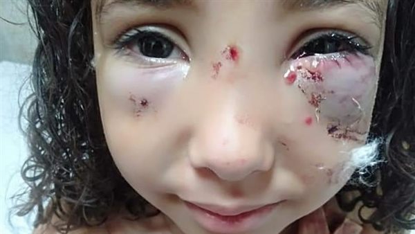 الطفلة جومانا المصابة