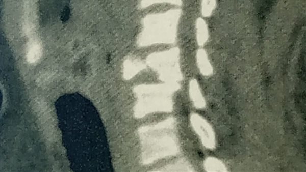 كسر عنقية مواطن أثناء