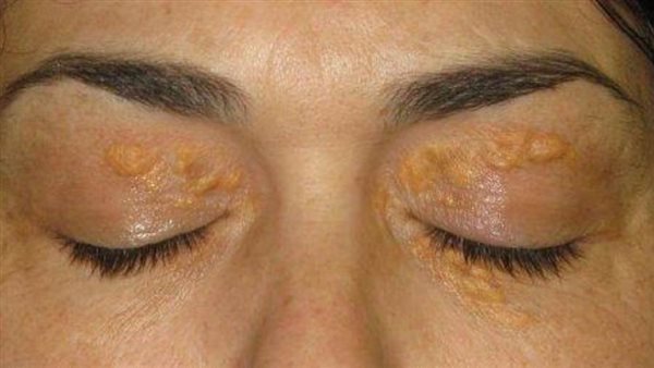 المرض الأصفر