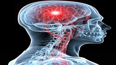 دراسة: ممارسة مرضى السكتات الدماغية للرياضة يقلل لديهم فرص الموت بمقدار النصف  