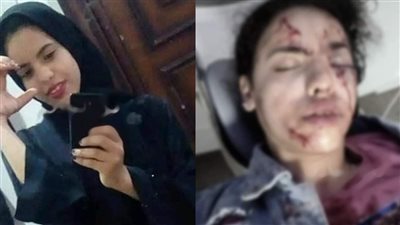 يتيمة الأب والأم.. تفاصيل فقدان طفلة لعينها في زفة بالشرقية| صور