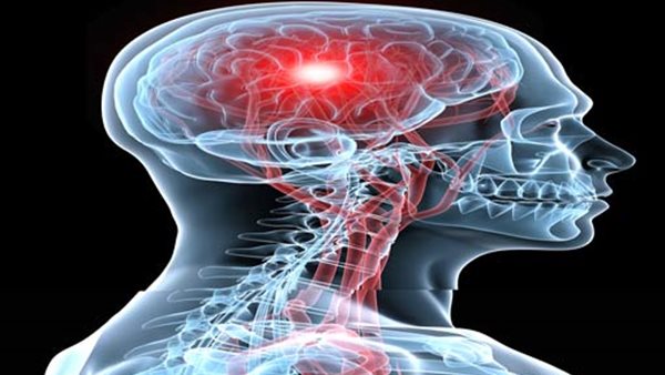 السكتة الدماغية -