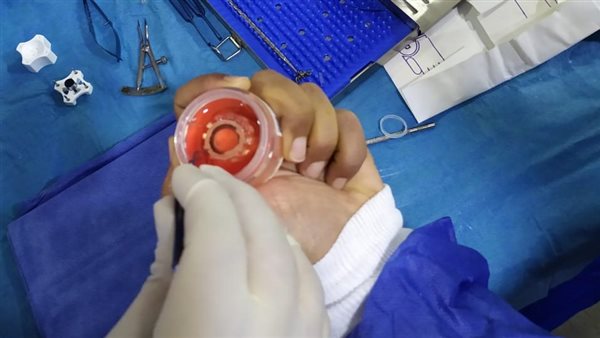 نجاح أول عملية زراعة