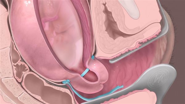 علميية ربط الرحم_
