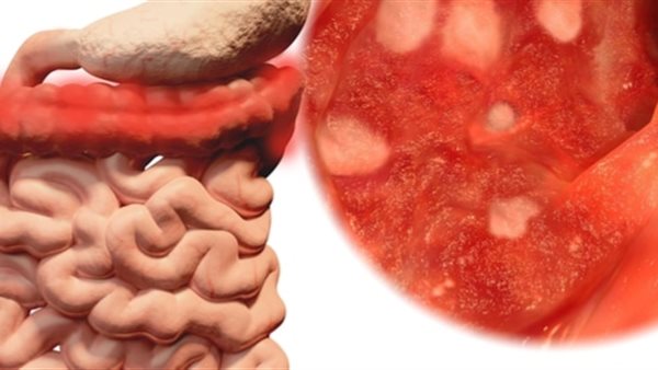 قولون تقرحي