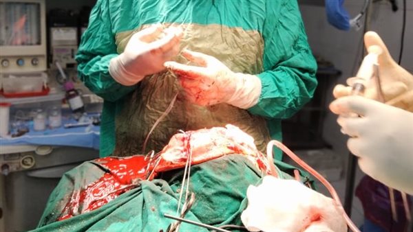  عملية إزالة ورم