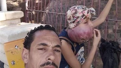 بعد نشر القاهرة 24.. الصحة تستجيب لاستغاثة الطفلة ريماس المصابة بورم في الحلق