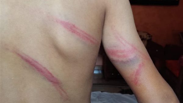 أثار التعذيب في جسد