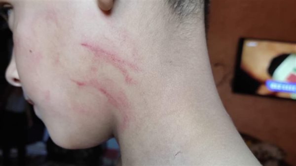 أثار التعذيب على