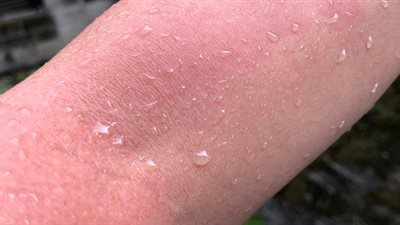 مرض حساسية الماء... تعرف على أسبابه وكيفية التعامل معه