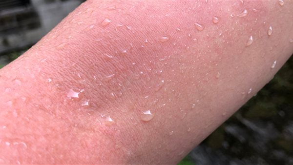 حساسية الماء