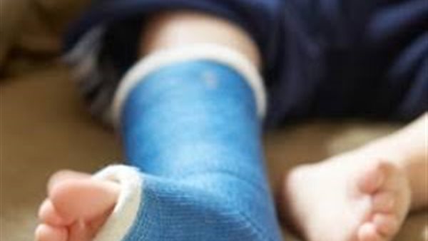 طفل مصاب بكسر - أرشيفية