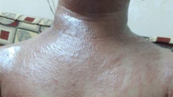 تعرض مواطن للسعات